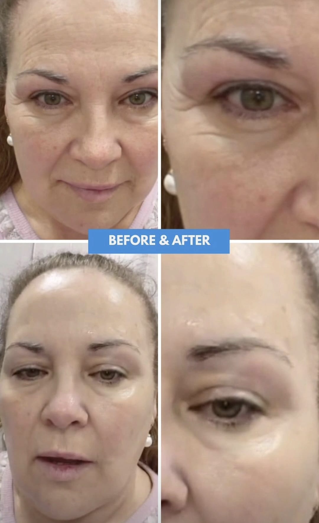 Halbea LightSkin Treatment Gesichtsmaske + Pad mit Hyaluron mit Soforteffekt
